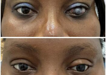 കോംഗോയില്‍ നിന്നുള്ള 42 വയസ്സുള്ള രോഗി സുഖം പ്രാപിച്ചു.