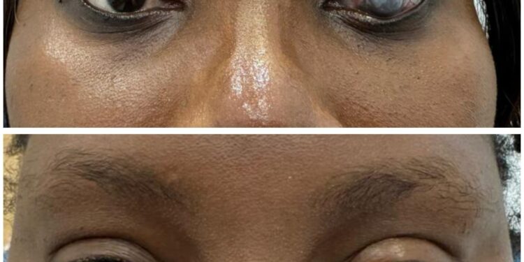 കോംഗോയില് നിന്നുള്ള 42 വയസ്സുള്ള രോഗി സുഖം പ്രാപിച്ചു.