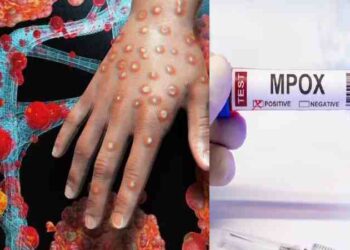 സംസ്ഥാനത്ത് വീണ്ടും എംപോക്സ്; ജാഗ്രത നിർദ്ദേശവുമായി ആരോഗ്യവകുപ്പ്