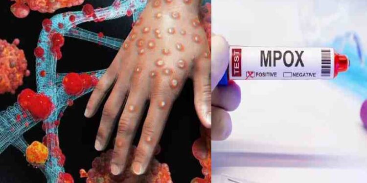 സംസ്ഥാനത്ത് വീണ്ടും എംപോക്സ്; ജാഗ്രത നിർദ്ദേശവുമായി ആരോഗ്യവകുപ്പ്